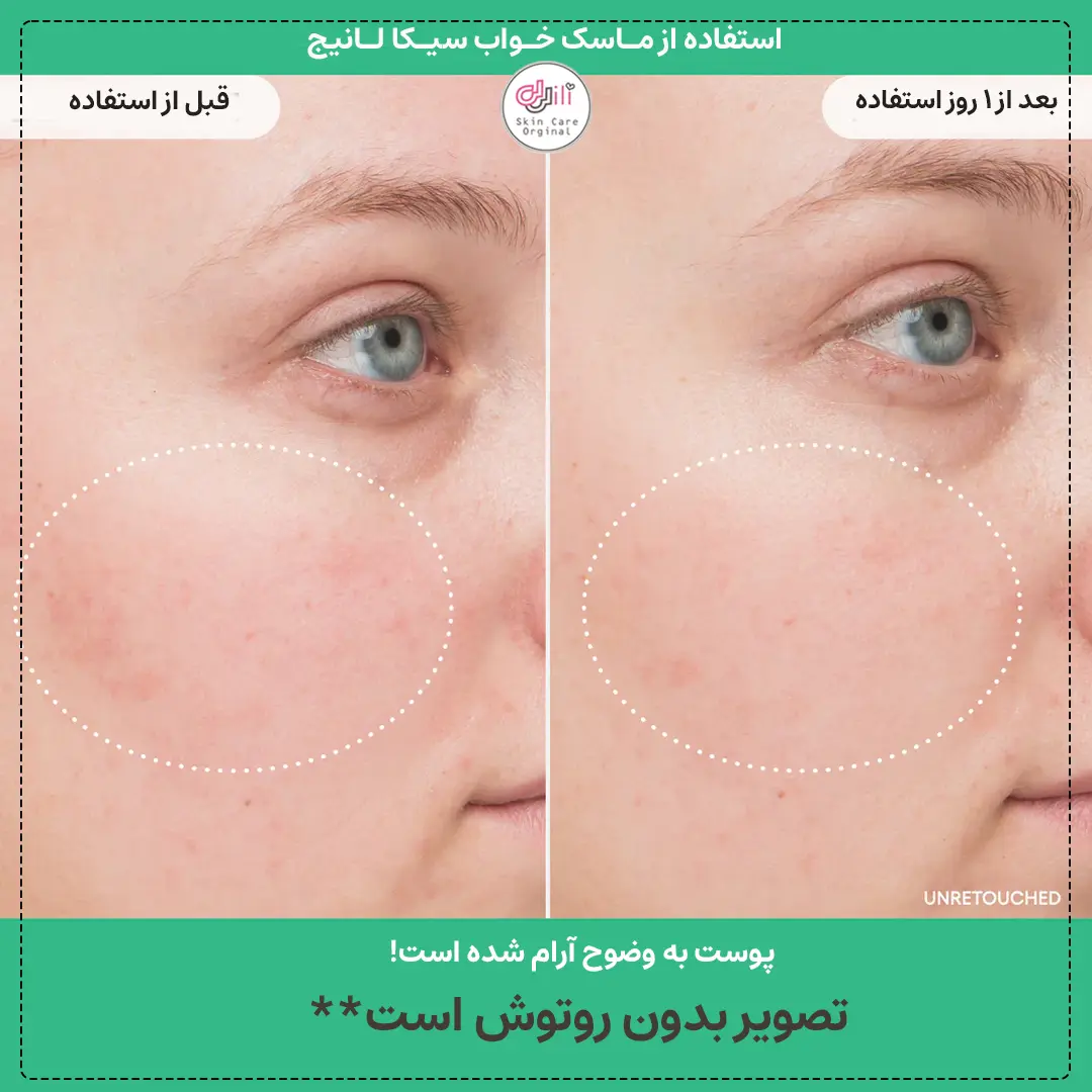 قبل و بعد ماسیک سیکا لانیج