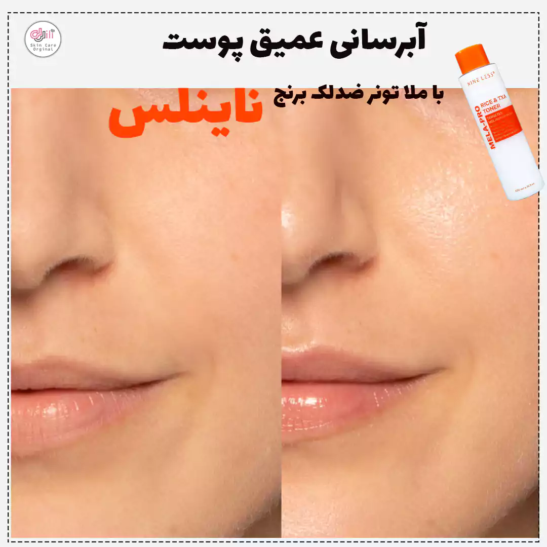 تونر آبرسان و ضدلک ناینلس
