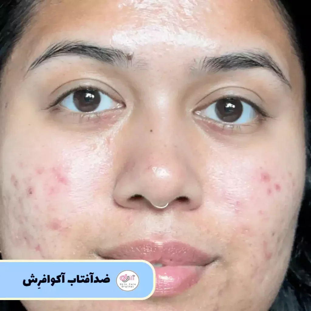 ضدآفتاب آکوافرِش روی پوست