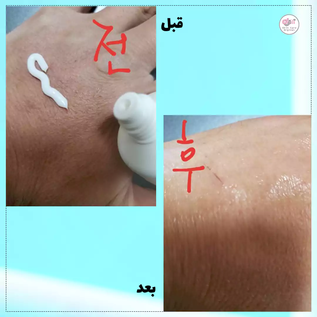 قبل و بعد از کرم جیگامبله