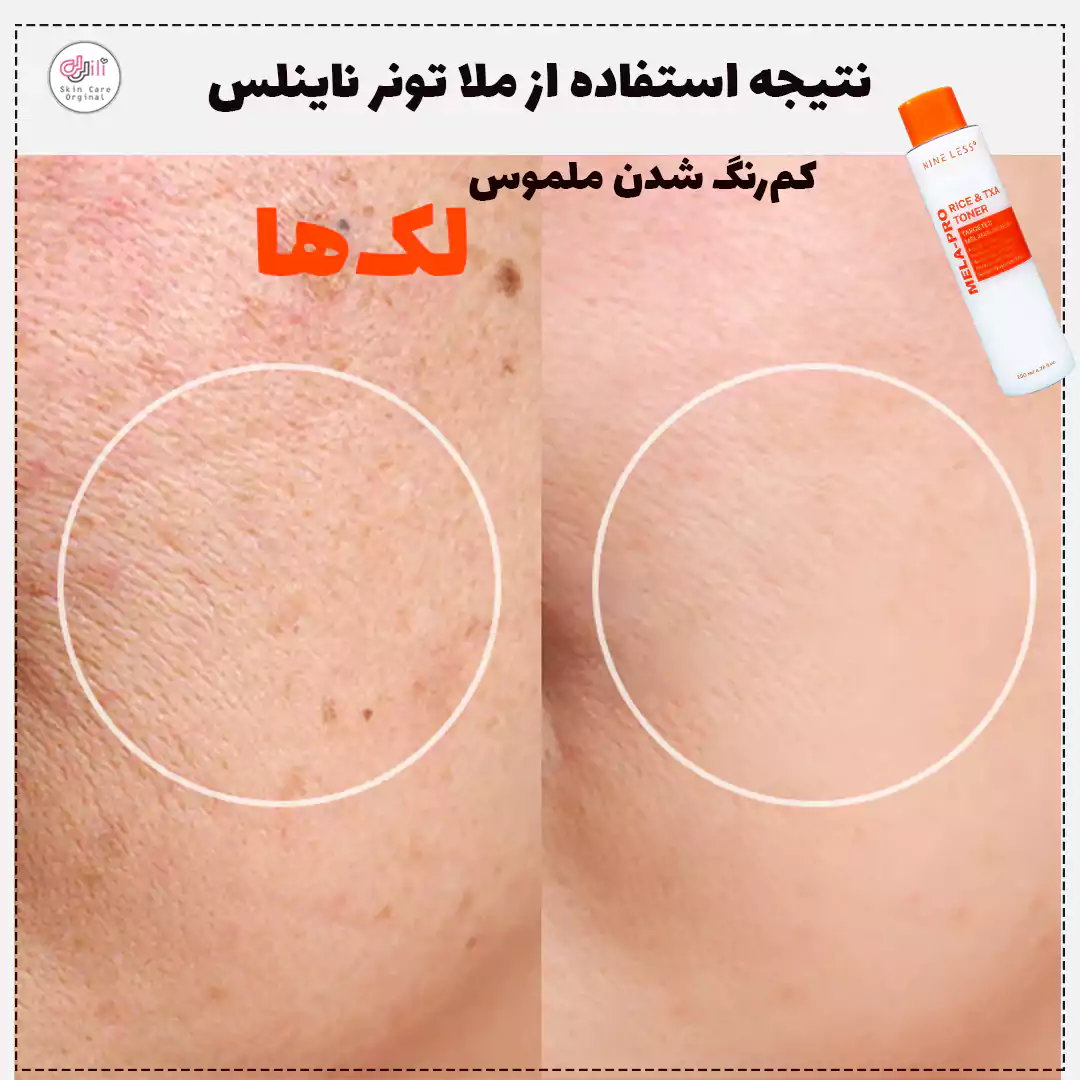 نتیجه استفاده از تونر ناینلس