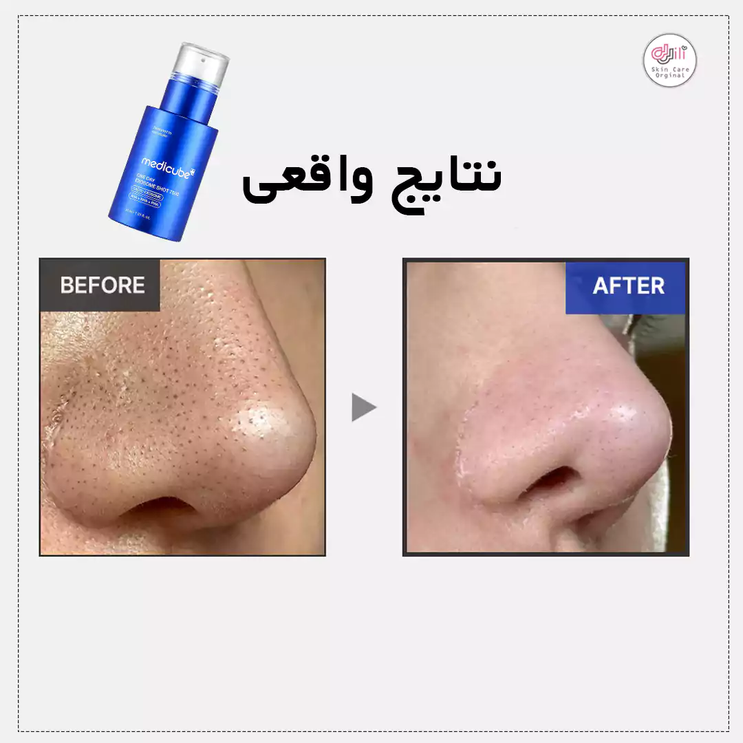 قبل و بعد از اگزوزوم شات مئی کیوب