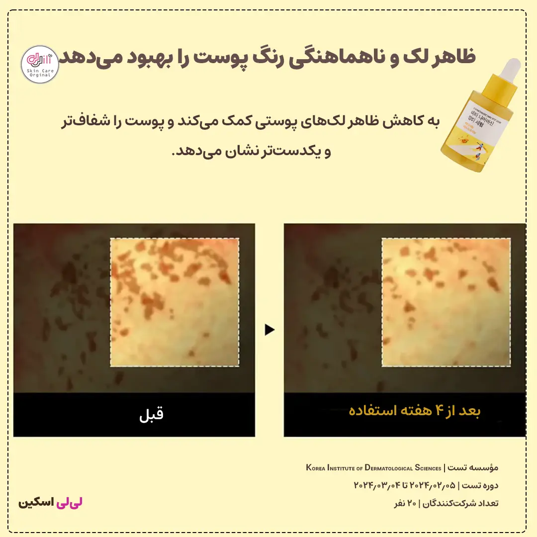 تست کلینیکی سرم نیاسینامید راندلب