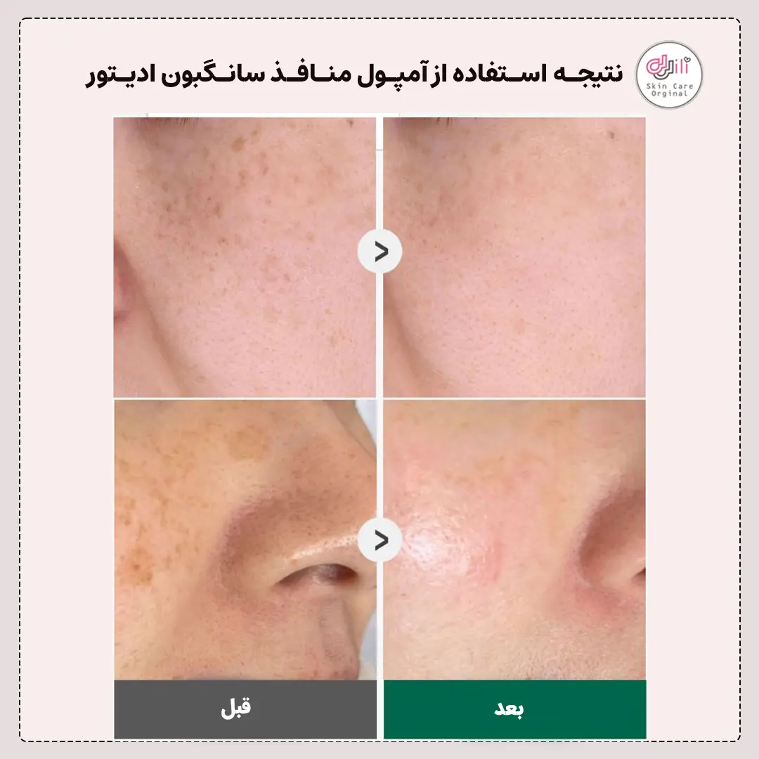 نتیجه استفاده از آمپول منافذ کره ای